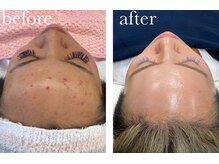 シュエットサロン 自由が丘(Chouette Salon)/ニキビ肌から艶肌へ～♪