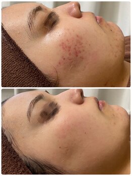 ビオエル 横浜店(Bioel)/ハーブピーリング/横浜