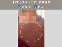 アンジュ(ANGE)/VOSサロンケア症例ニキビ