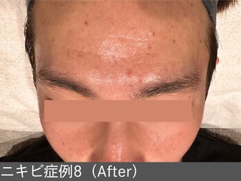 オアシスラグーン(OASIS LAGOON)/ニキビ改善(症例8 after)