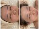 リンダ(Rinda)の写真/8種類のピーリングで大人女性のシミケア/シワケアに特化◎肌質別・お悩み別にアプローチでノーファンデ◎