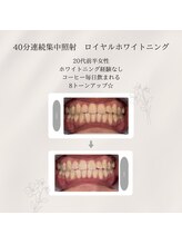 プラスビーセルフ(+b self)/ホワイトニングビフォーアフター