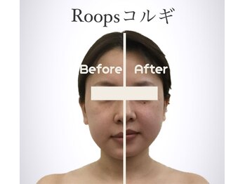 ループス(Roops)/ビフォーアフター【コルギ】