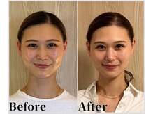 整体ラルース 中目黒(LALUZ)/20代 女性 頭蓋骨小顔矯正　変化