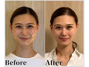 整体ラルース 中目黒(LALUZ)/20代 女性 頭蓋骨小顔矯正 変化