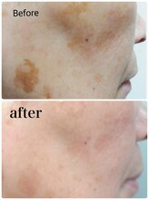 リジュベネ(rejuvena)/【本気のシミケア！白玉スノー】