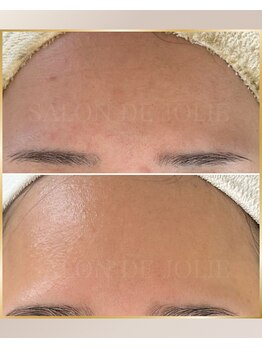 サロンドジョリー/倉敷ハーブピーリング