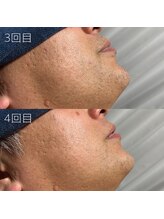 カナウ(KANAU)/ヒゲ脱毛（40代前半男性）