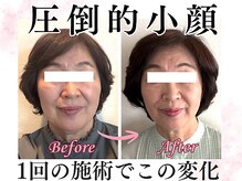 ジュピテールの雰囲気（別人級の小顔効果！たるみ・むくみ・V字ラインの圧倒的変化★）