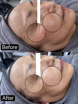 リル(Rire)/Before→After　50代