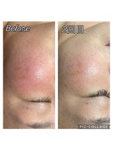 フリージア(Beauty Salon Freesia )/美肌菌活ピールで酒さ、赤み改善