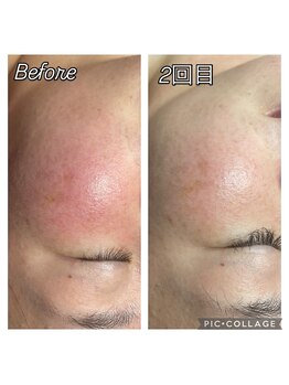 フリージア(Beauty Salon Freesia )/美肌菌活ピールで酒さ、赤み改善