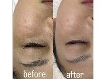 気になるシミ・シワ・肌質改善はお任せください☆