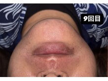 ベルフィオーレ(bel fiore)/30代男性　9回目 After