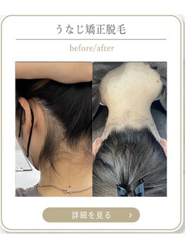 ミース 上野店/うなじ矯正の魅力♪