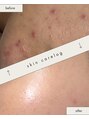 チュラ(Chu.ra) 腸から整えるビオスチームで、10代からの長年の肌悩みに変化!