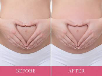 マロズワックス ブラジリアンワックスアンドスパ(Maro's Wax Brazilianwax Spa)/マタニティＷａｘ★Before Afte
