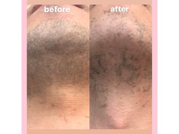 ディライト 名古屋駅店(Delight)/顎下脱毛（髭脱毛）