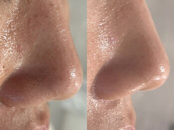 ビューティービレッジ(Beauty village)/開き毛穴、詰まり/黒ずみ毛穴