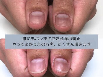 アリエ(allie)/爪の悩みは人それぞれ
