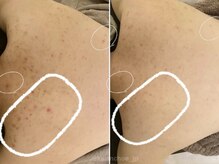 カランコエ(KALANCHOE)/背中のしつこいトラブルにも！