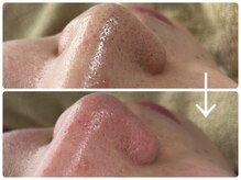 ニコ(Nico)/毛穴エクストラクション