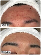 アロマ(AROMA)/ヒゲ脱毛4回目/越谷