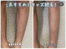 ビヨウイリョウテイケイ プリード(美容医療提携 PULIDO）)/キッズ脱毛