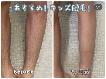 ビヨウイリョウテイケイ プリード(美容医療提携 PULIDO）)/キッズ脱毛