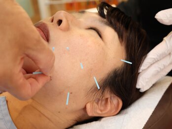 あさがお鍼灸整骨院の写真/【鍼デビューにオススメ】手技では届かない深部にアプローチ★あなたの急な痛み、蓄積したお悩みを改善◎