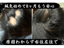 セントラル鍼灸院リラクシー(Re:laxy)/40代女性原因わからず抜毛に困惑
