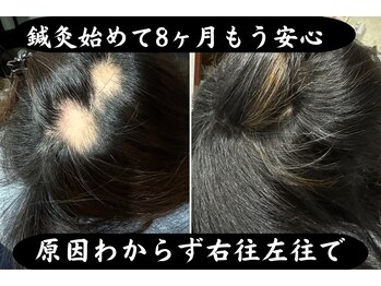 セントラル鍼灸院リラクシー(Re:laxy)/40代女性原因わからず抜毛に困惑