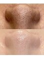 レシェルサロン(Lechelle Salon) REVIハーブピーリグ 毛穴黒ずみ 毛穴開き