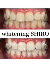 福岡ホワイトニングシロ 天神中洲店(福岡ホワイトニングSHIRO)/【ホワイトニング】before/after