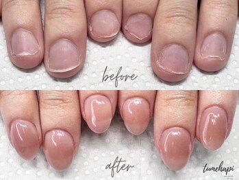 ツメハピ(tumehapi)/深爪ケア ビフォーアフター