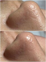 スパークル/フェイシャル/角質ケア/毛穴ケア