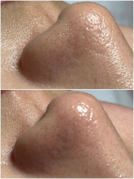 スパークル/フェイシャル/角質ケア/毛穴ケア