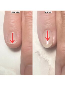 プレシャスハート 広島(Precious Heart)/自爪育成経過写真