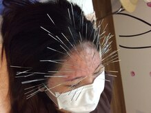 周りと差をつけられるほど見た目が変わる美容鍼ルート鍼。