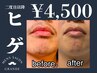 【何回でも◎】ヒゲ脱毛1回　￥4500 #メンズ脱毛