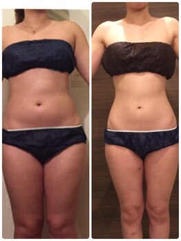 エステサロン 美飾り イオンモール木更津店/before⇒after/全身痩せ