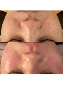 ラナ 京都西院店(Lana)/繰り返すシミにアプローチ