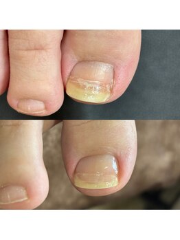 リリ(lili)/巻き爪矯正2回目(右親指)