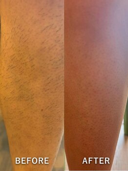 ビークリア(B.clear)/メンズ全身脱毛（顔＋VIO込）