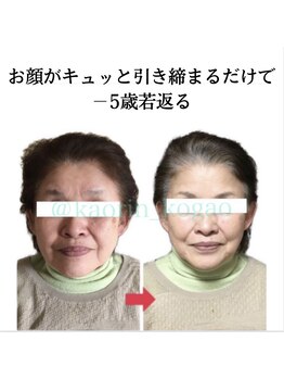 顔凛(カオリン)/60代女性の小顔矯正