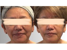 リズ(rE:S)/プラズマ+エステリジュラン60代