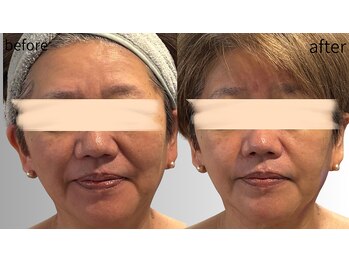 リズ(rE:S)/プラズマ+エステリジュラン60代