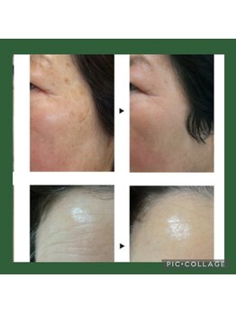 ルース(LUCE)/ピュールボーテ★シミもシワも◎