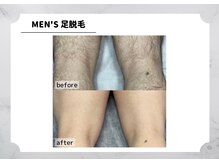 アルゴ 福津店(ALGO)/【メンズ】足脱毛