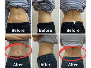 Noa接骨院 はりきゅう院/脂肪冷却 B/A写真